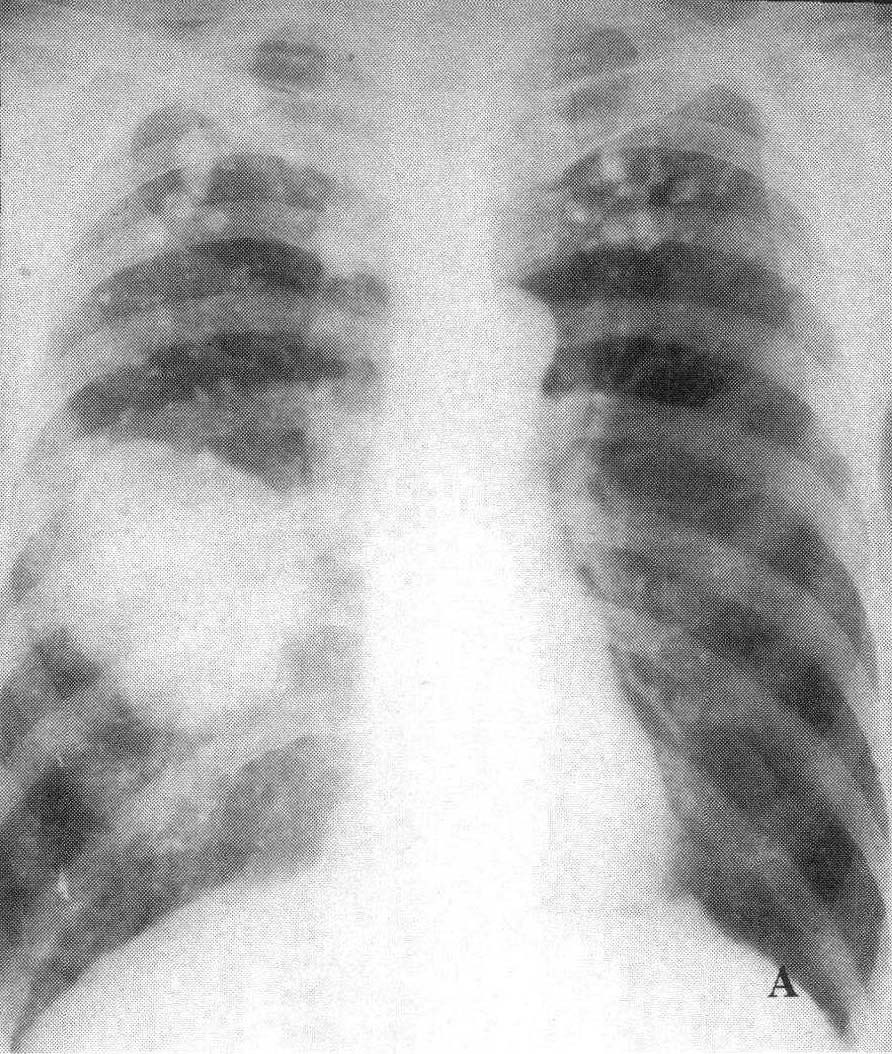 (图) 肺结核合并肺癌